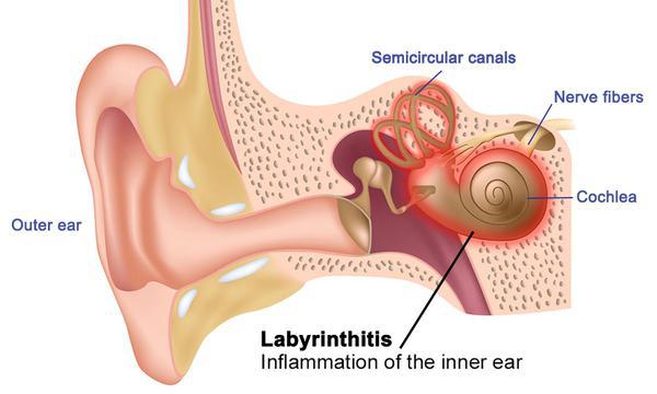 Labyrinthitis