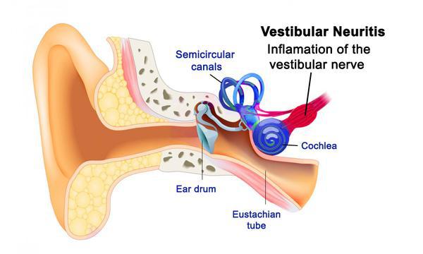 Vestibular Neuritis