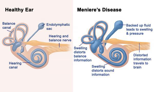 Meniere's Disease