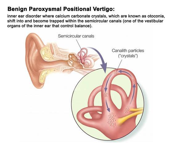 Positional Vertigo