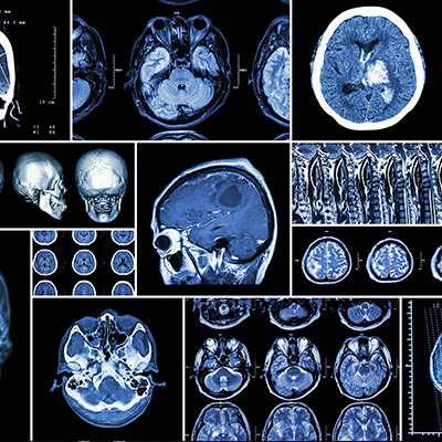 Head and Neck Tumors Irvine